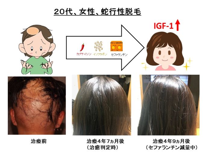 円形脱毛症　病院